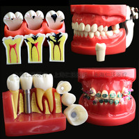 Różne modele zębów dentystycznych są używane do nauczania i materiału dentystycznego szpitala 4